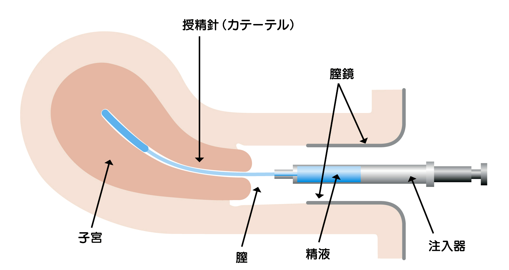 子宮口精子注射画像 選別精子子宮内注入法